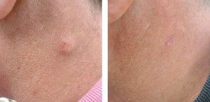 cyst-removal-before-and-after
