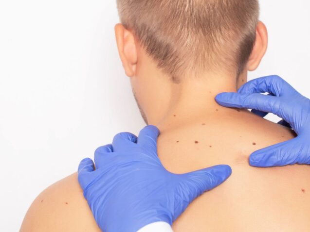 Skin Cancer Risk Factors and Surgical Solutions