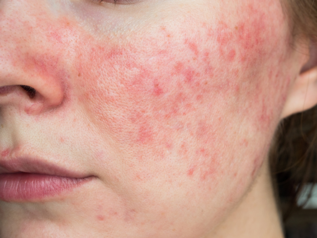 Does Acne Get Better in The Summer Months?