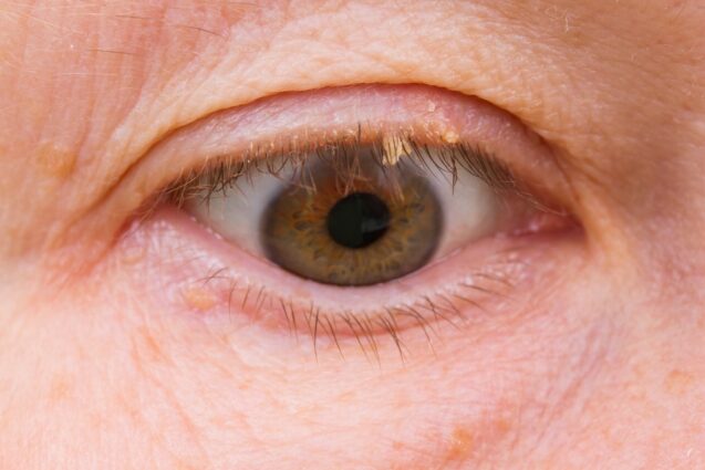 How Do I Remove a Skin Tag  on My Eyelid?