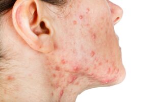skin acne