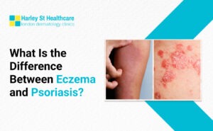 Difference Between Eczema and Psoriasis
