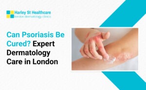Can psoriasis be cured?
