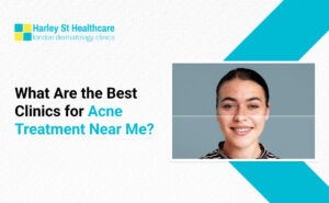 What Are the Best Clinics for Acne Treatment Near Me?