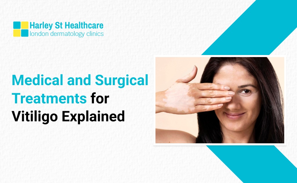 Medical and Surgical Treatment for Vitiligo in London: Explained