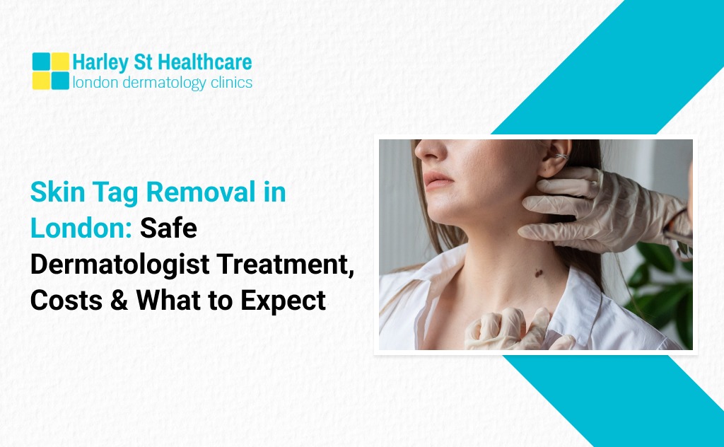 Skin Tag Removal in London: Safe Dermatologist Treatment