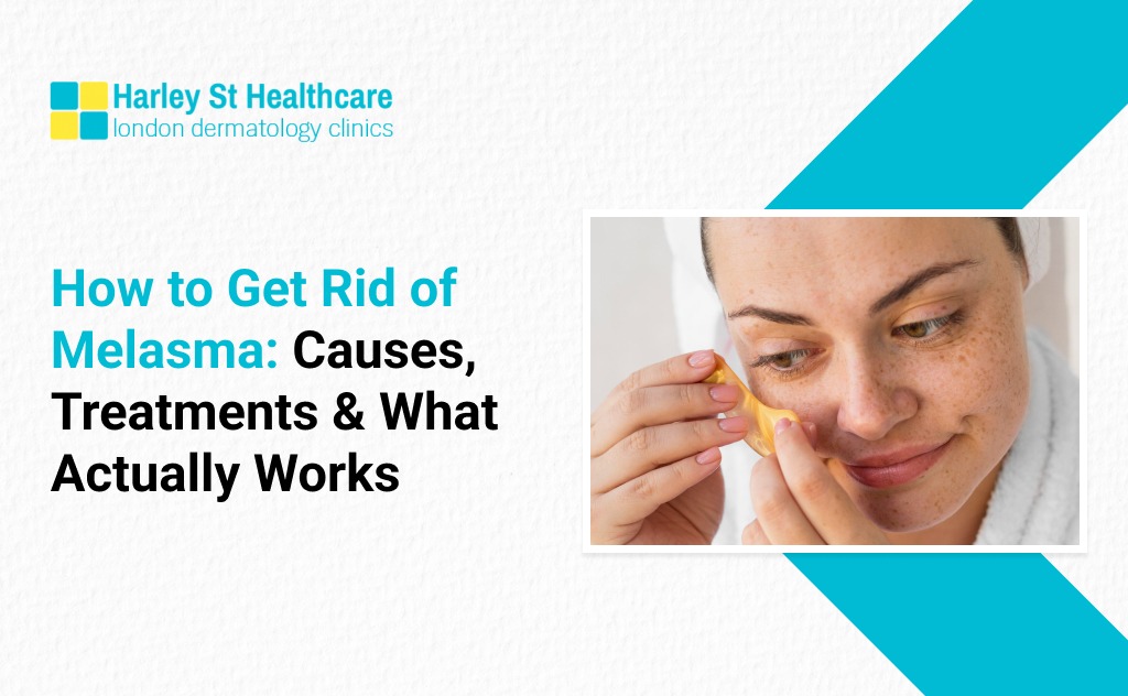 How to Get Rid of Melasma: Causes, Treatments