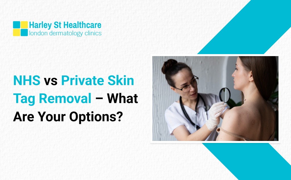 NHS vs Private Skin Tag Removal
