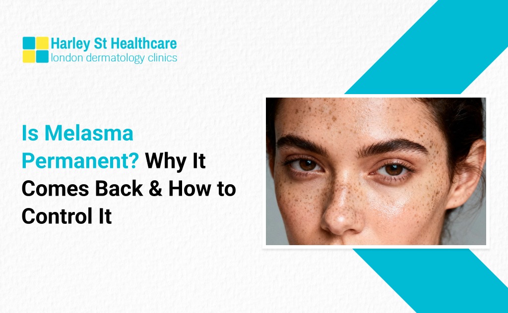 Is Melasma Permanent? Why It Comes Back & How to Control It