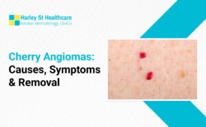 Cherry Angiomas: Causes, Symptoms & Removal in London