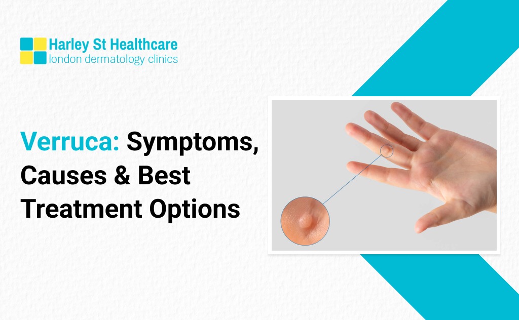 Verruca: Symptoms, Causes & Best Treatment Options