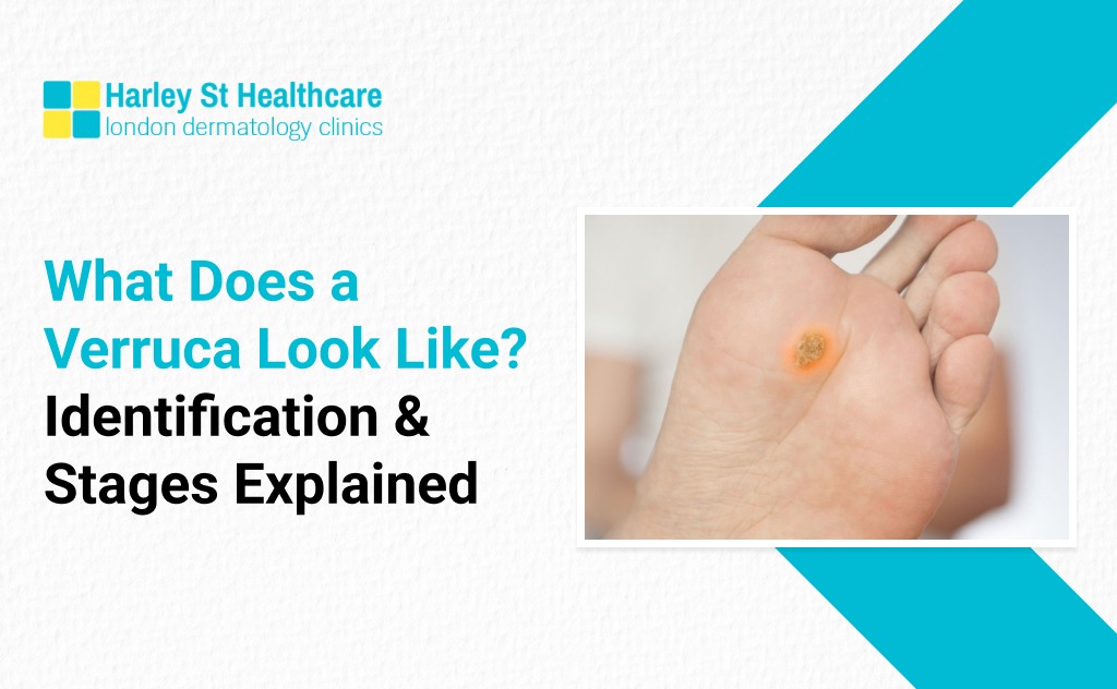 What Does a Verruca Look Like? Identification & Stages Explained