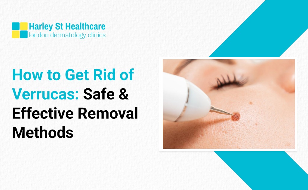 How to Get Rid of Verrucas: Safe & Effective Removal Methods