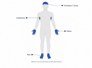 A front-facing human body silhouette in light grey, with four areas highlighted in deep blue: underarms, palms, forehead/scalp, and feet. Small label dots next to each highlighted area. Subtitle in smaller text below the illustration: "Where it occurs and how severe each area is."
