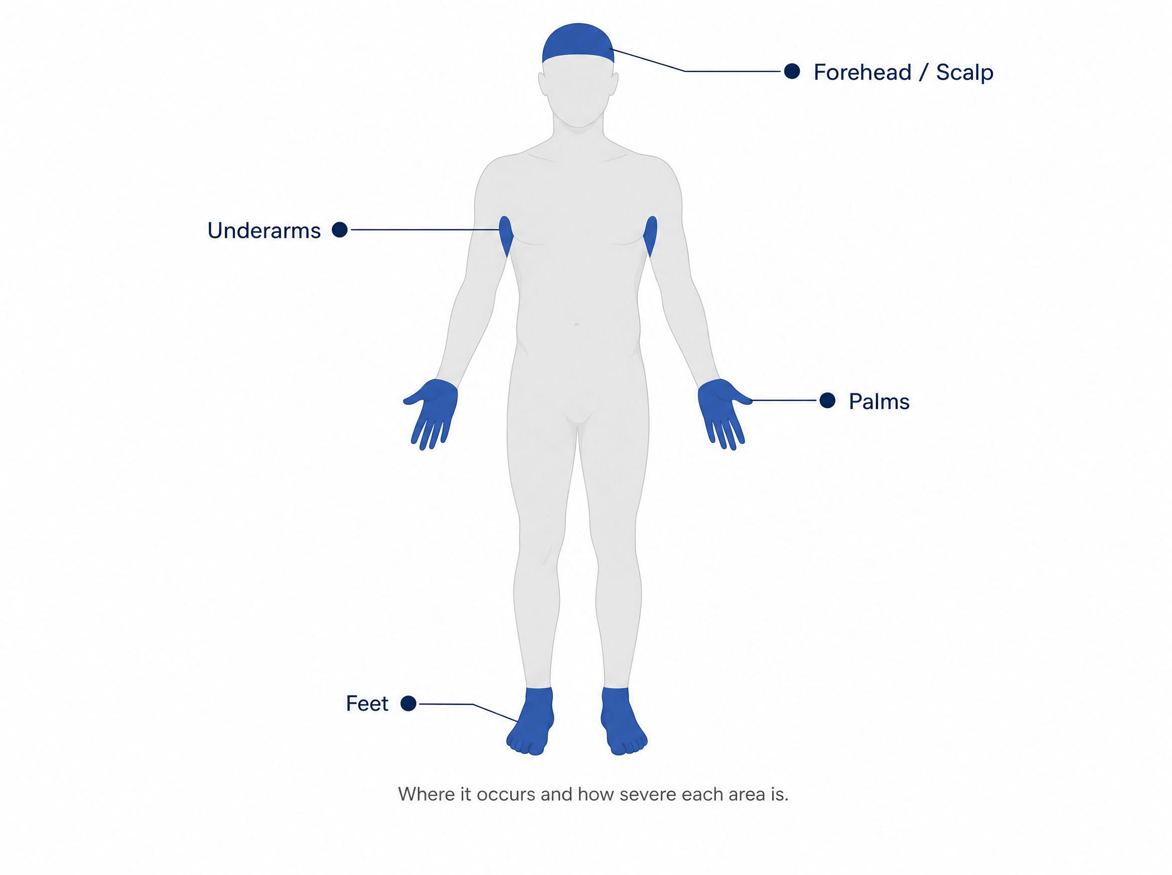 A front-facing human body silhouette in light grey, with four areas highlighted in deep blue: underarms, palms, forehead/scalp, and feet. Small label dots next to each highlighted area. Subtitle in smaller text below the illustration: "Where it occurs and how severe each area is."