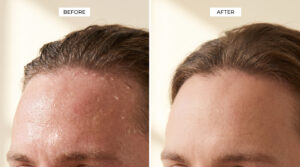 scalp and face before and after treatment