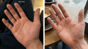 Hands and feet before and after sweat solution treatment