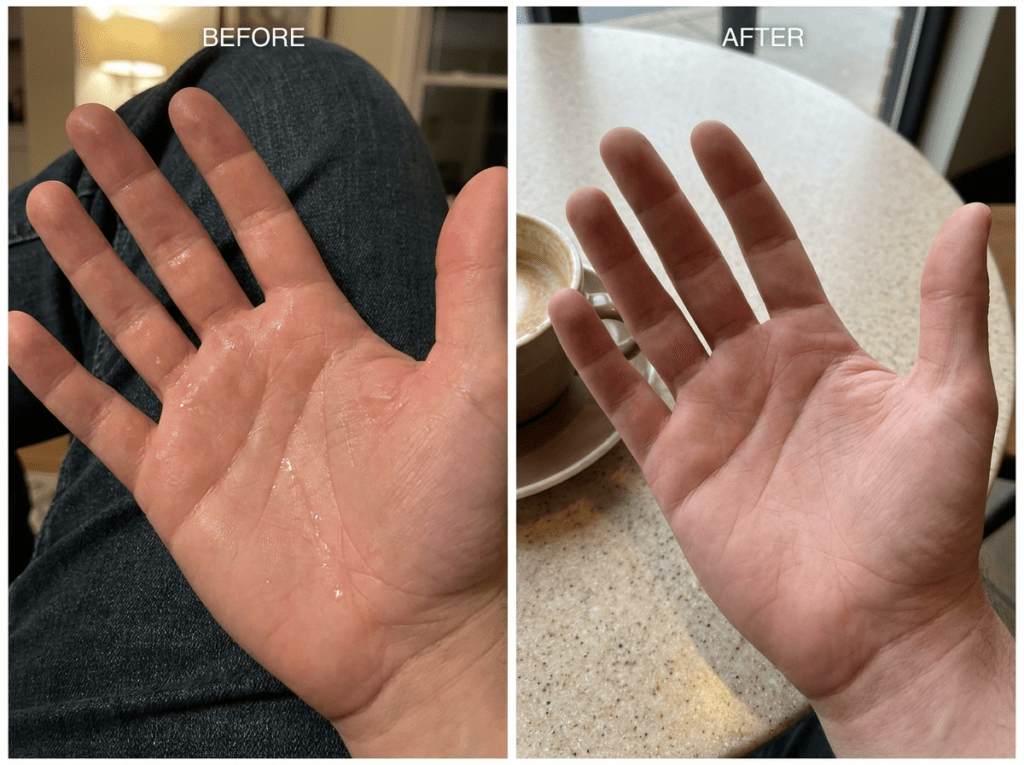 Hands and feet before and after sweat solution treatment