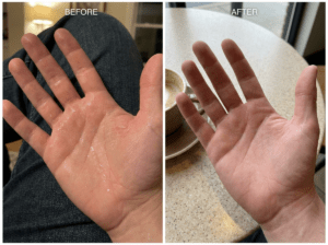 Hands and feet before and after sweat solution treatment