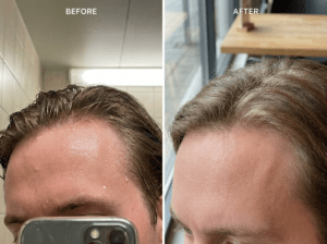 scalp and face before and after treatment